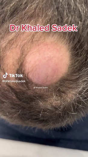 Massive Pilar cyst #drkhaledsadek #skincare #cystremoval | pilar cyst removal