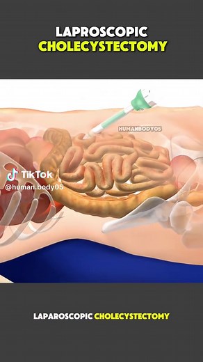 Understanding Laparoscopic Cholecystectomy Procedures