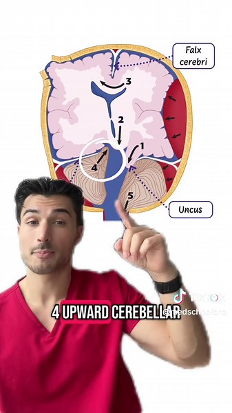 Understanding Brain Herniations in Neurology