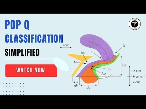 POP-Q Classification Simplified | Pelvic Organ Prolapse Staging Explained