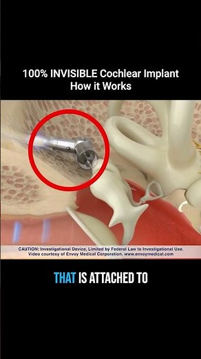 The New INVISIBLE Cochlear Implant