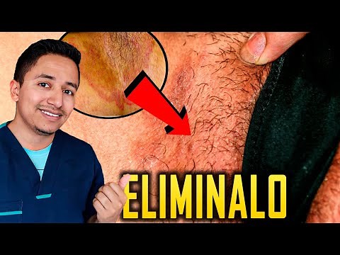 How to CURE Jock Itch, medications for jock itch