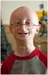 Hutchinson-Gilford Progeria Syndrome – a disease of accelerated aging due to Alternative Splicing - AGINGSCIENCES™ - Anti-Aging Firewalls™