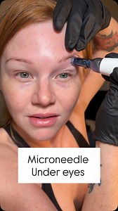 My most highly requested video! How to microneedle under (and around) eyes @drpenglobal @bruun.beauty #skincare #diybeauty #microneedle #undereyecircles #darkcircles #stemcells | Krystn Walmsley