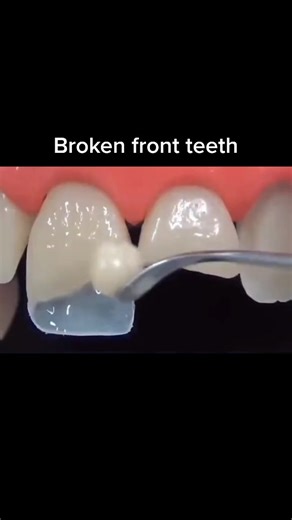 Front Teeth Restoration: Dental Filling Process Explained