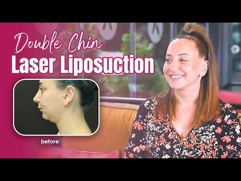 3 Months After Double Chin Liposuction in Turkey | Seren’s Jawline Result at AKM Clinic