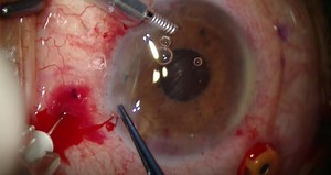 Yamane Technique - Eyetube