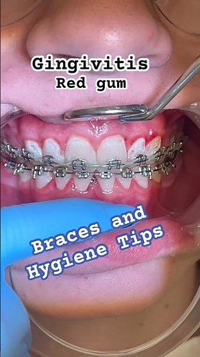 Oral Hygiene Tips for BRACES