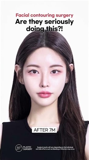 Best Facial Contouring Surgery Korea | Cheekbone Reduction & Jawline Reduction Before and After