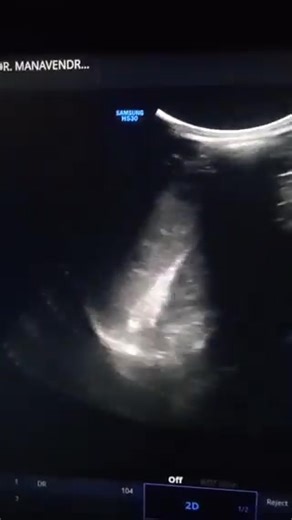 Splenic tuberculosis with retroperitoneal nodal involvement. | إستشاري امراض الباطنة والكبد د محمد الجمال