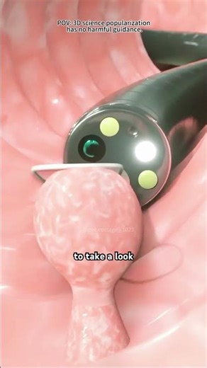 How Polypectomy Is Done (3D Animation)