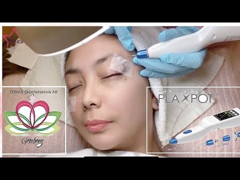 Electrocautery Warts Removal Procedure (How to Remove Warts)