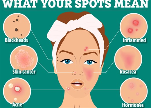 What your SPOTS reveal about your health - when you should and SHOULDN'T squeeze