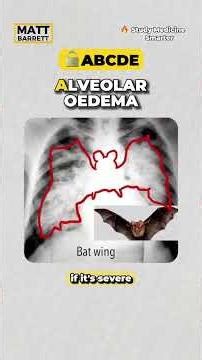 Easily recall the x-ray features of pulmonary oedema for your medical exams