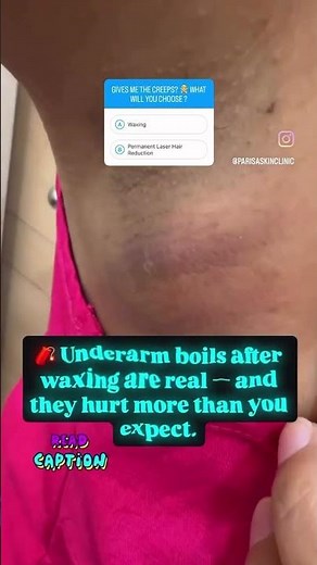 From Smooth to Swollen:One Mistake You Should Avoid! Waxing Gone Wrong: Painful Boils in Underarms!