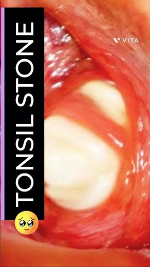 Tonsil Stones - 😱 Tonsilith How to remove it At Home