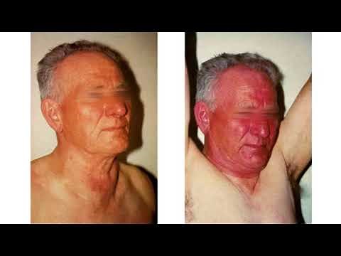 Description du signe de Pemberton