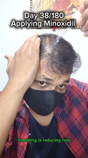 Day 38/180 of using Minoxidil | Less hair is shedding now #hair #minoxidil #minoxidilresult