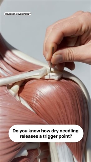 How Does Dry Needling Help Release a Trigger Point? | Physiotherapy #shorts