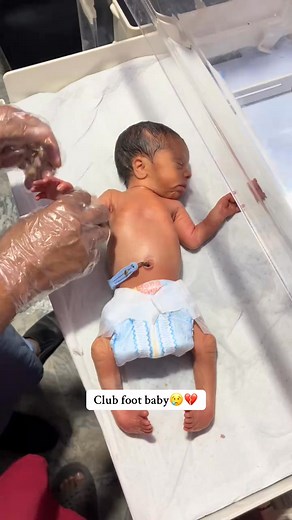 Baby born with club foot😭💔 #twistedfeet #clubfoot #nicubaby #drnadeem___ | Farm Kingdom