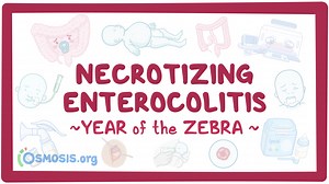 Necrotizing enterocolitis: Year of the Zebra 2024: Video, Causes, & Meaning | Osmosis