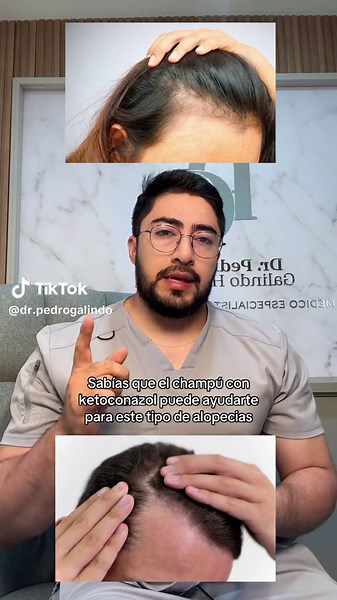 Shampoo con ketoconazol en alopecia