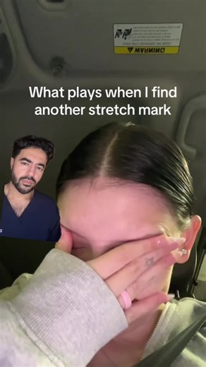 Effective Tips to Improve Stretch Marks