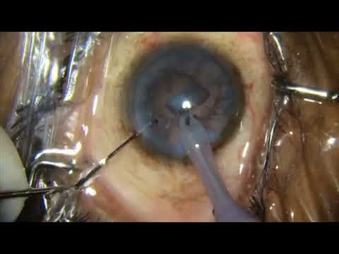 Phaco divide and conquer