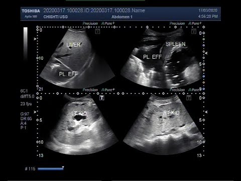 Ultrasound Video showing Bilateral renal parenchymal disease, pleural effusion, and ascites.