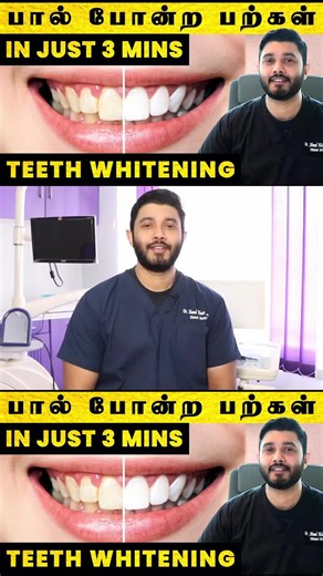 Instant Teeth Whitening At Home: Tamil Guide