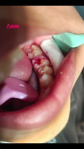 Treatment Done ✅ Composite Restoration 🦷 #dentist