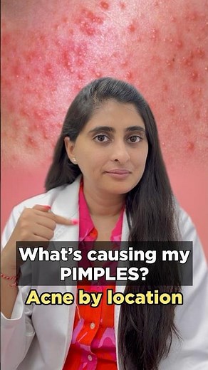 Pimples on face | How to treat acne and pimples on face | What acne means | Dermatologist