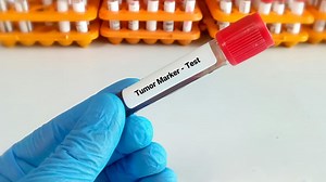 Biomarker Testing Is Important For Cancer Diagnosis And Treatment, Here's Why