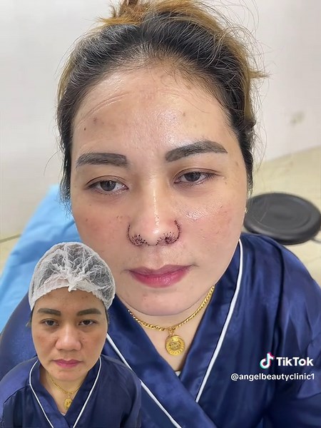 just after 60 minutes and this is the result of trim alar and sexy alar #surgery #sexyalar #trimalar #rhinoplasty #goretex #liposuction #Foxeyes