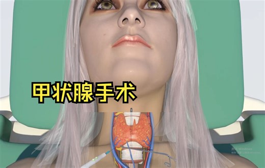 【医学3D】甲状腺切除术