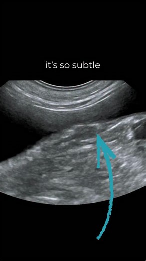 eVet Guides - Veterinary Ultrasound Guides on Instagram: "the uterus is a tricky little thing!! for those of you living in countries where entire animals are common, what uterus ultrasound tips can you share with our colleagues? . . . . . #evetguides #veteducation #vetultrasound #vetmed"