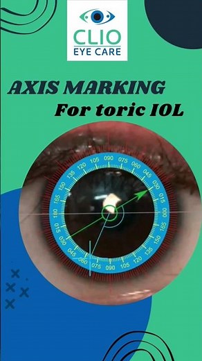 Axis Marking for Toric IOL #cataractsurgery| CLIO Eye Care