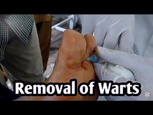 How to Remove Warts | Causes of Warts | Treatment of Warts