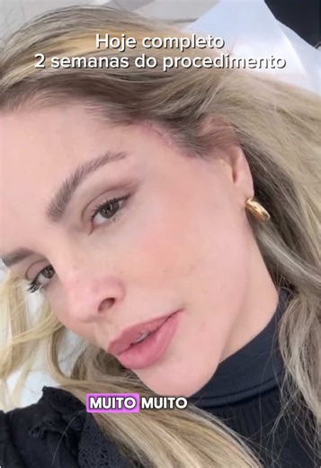 Sim, eu fiz o lifting facial e fiz por mim. Porque eu sou vaidosa, sim e me sentir bem comigo mesma sempre foi parte de quem eu sou. Essa foi uma escolha com propósito: valorizar minha melhor versão dentro da fase que eu vivo hoje, com respeito ao tempo, mas também com a consciência de que posso e mereço me cuidar.