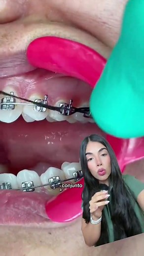 Cadenas para Brackets: Usos y Tipos