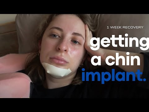 Recovering from chin implant | my experience