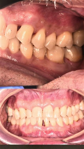 De dolor a estabilidad perio: cambios clínicos y radiográficos reales. Caso completo próximamente