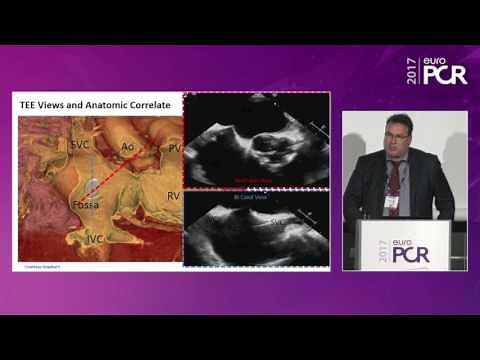 Cardioband: clinical reality for mitral and tricuspid valve repair - EuroPCR 2017