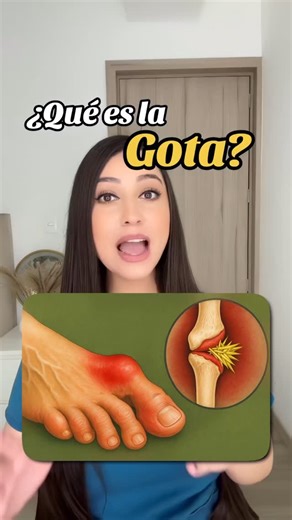 Paulina Zúñiga on Instagram: "¿Qué es la gota? 👩🏻‍⚕️ La gota es una forma común y compleja de artritis que puede afectar a cualquier persona. Se caracteriza por ataques repentinos y graves de dolor, hinchazón, enrojecimiento y sensibilidad en una o más articulaciones, a menudo en el dedo gordo del pie. Un ataque de gota puede ocurrir de manera repentina y con frecuencia puede hacer que te despiertes en el medio de la noche con la sensación de que el dedo gordo del pie está en llamas. La arti