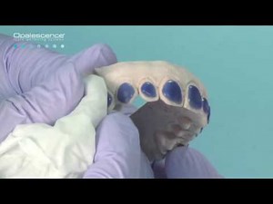 Precise Bleaching Tray Fit and Adaptation