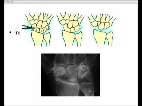 Four corner fusion vs Proximal Row Carpectomy
