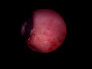 Kidney Stones. The Power Of ECIRS. • Video • MEDtube.net