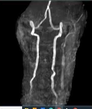 Absent carotid arteries (carotid occlusions)
