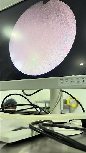 URSL or LASER stone surgery