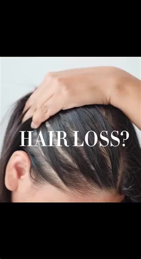 Microneedling with exosome therapy for hairloss . #microneedling #exosom #hairloss #scalp #dermatology #exosometherapy